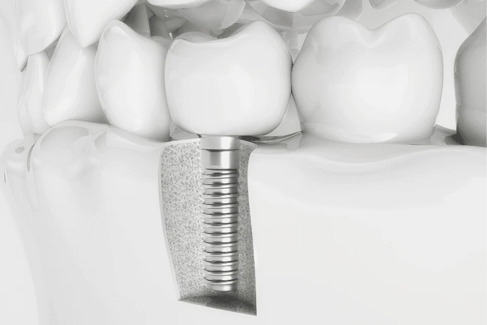 沒有牙根可以做假牙嗎