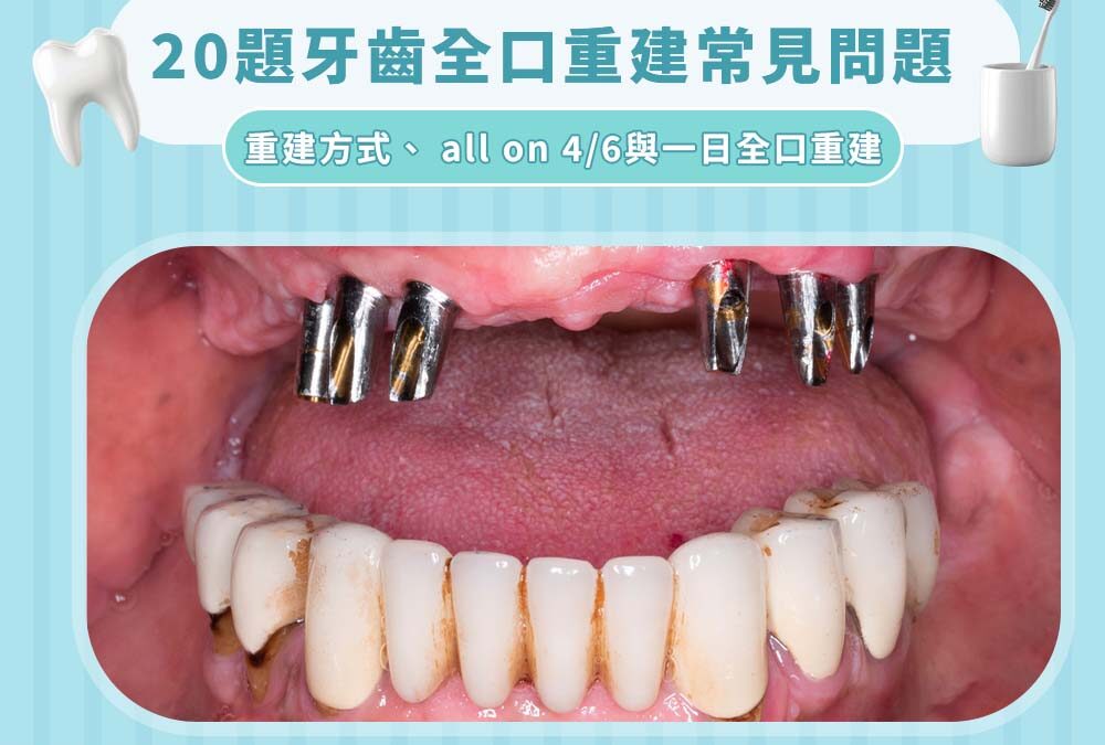 全口重建