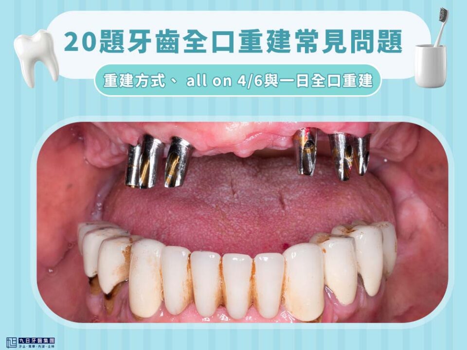 全口重建